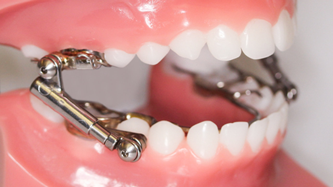 Interceptive Orthodontic treatment ( Phase I Braces)