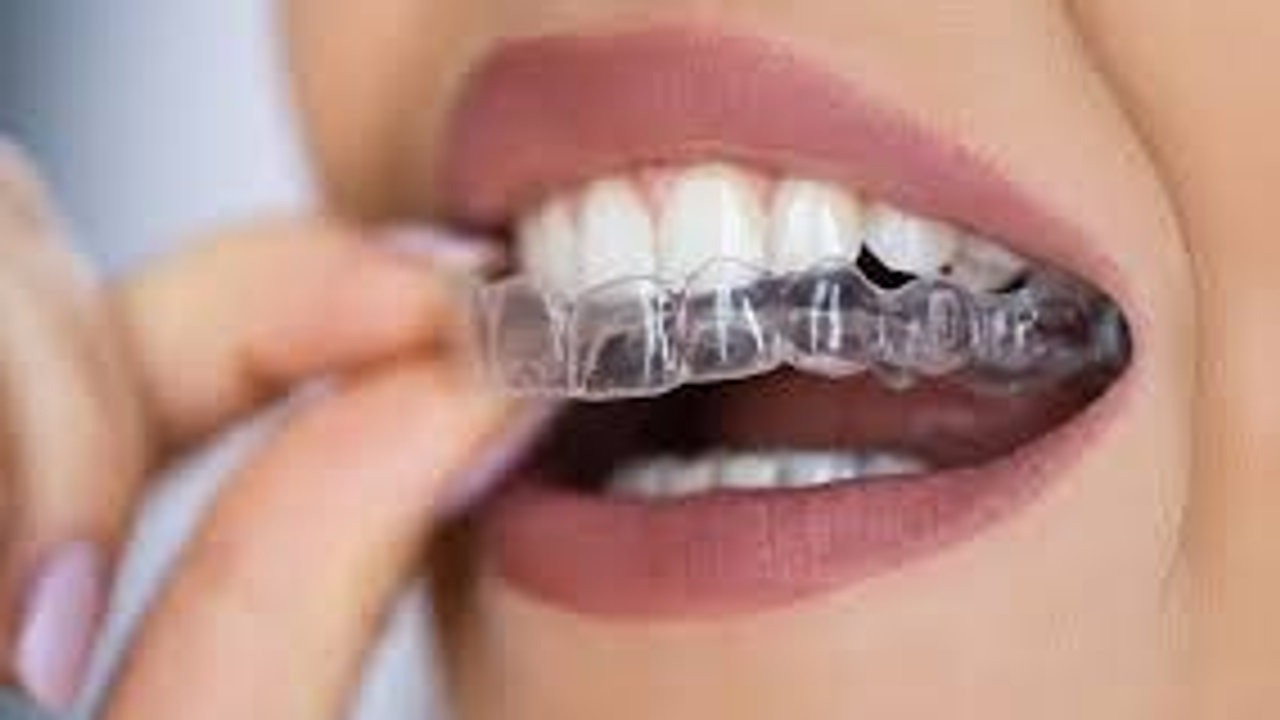 Are Clear Braces Right For Me (Clear Correct or Invisalign®)?