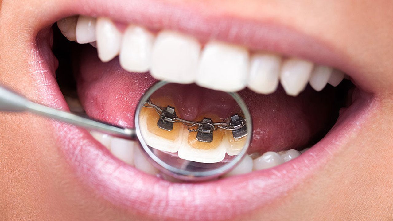 Lingual Braces