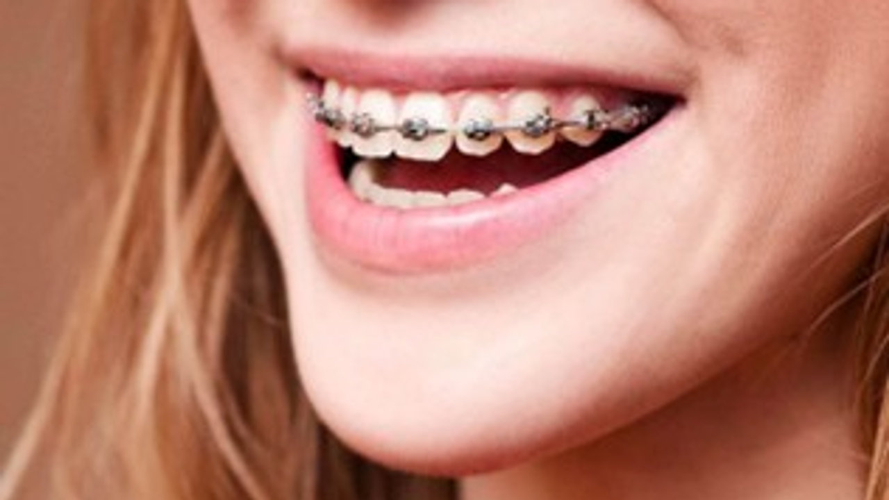 The Top 5 Common Myths About Braces You Should Stop Believing