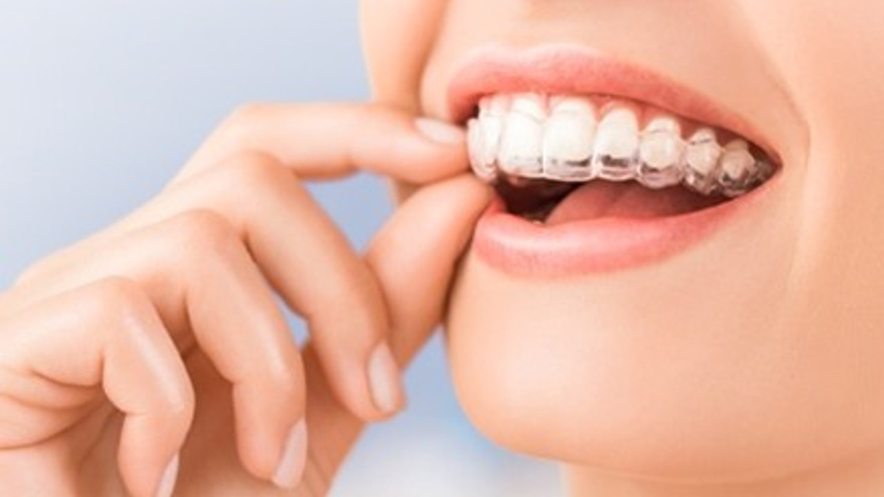 Why You Need Retainers after Braces and Clear braces (ClearCorrect or Invisalign)