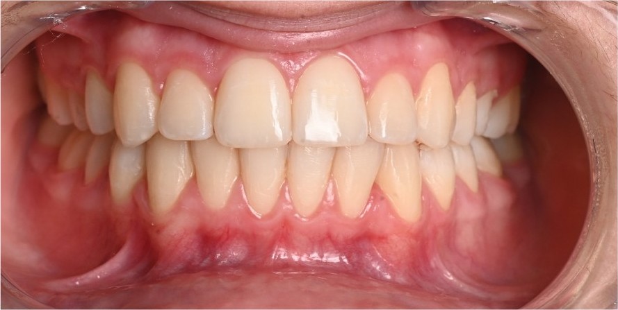 Aligned upper teeth with healthy, even gum contour after treatment