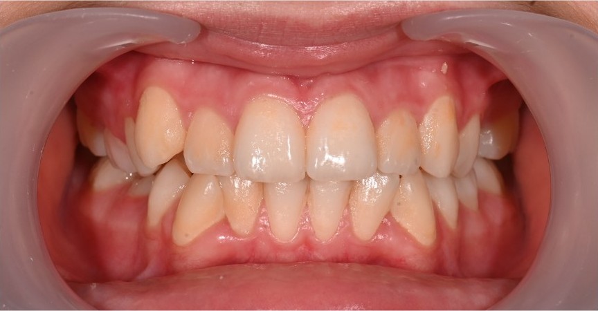 Crowded upper teeth with uneven gum contour before treatment