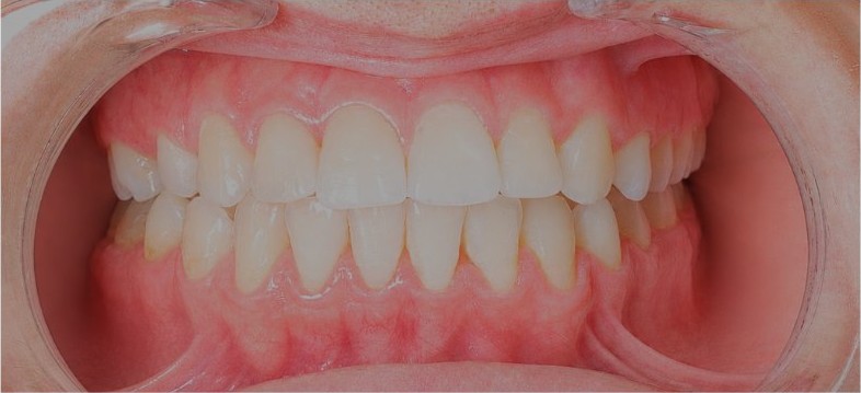 Closed bite with corrected occlusion after eleven months of retreatment