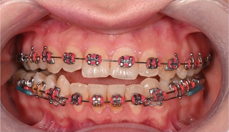 Anterior open bite and posterior crossbite before retreatment