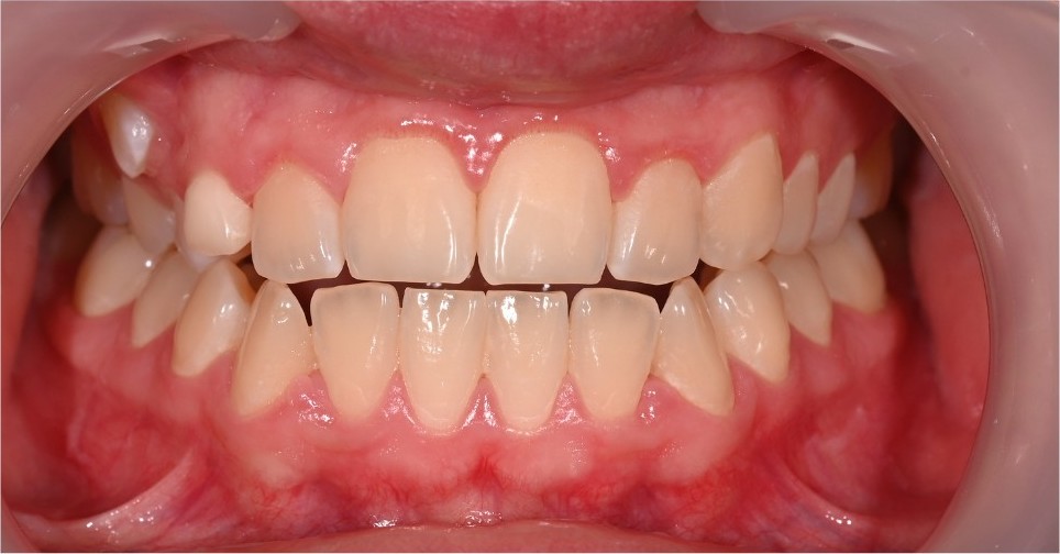 Ectopic canine sitting out of position in the upper arch before treatment