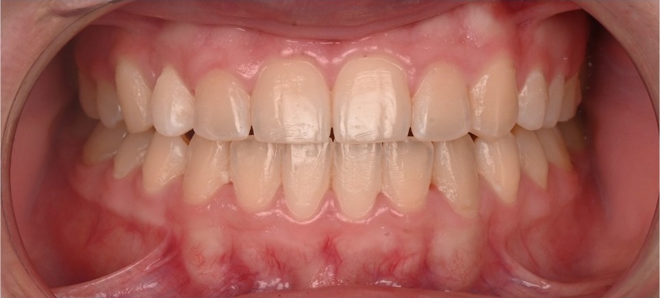 Aligned arches and a stable, balanced bite after orthodontic treatment and implant placement