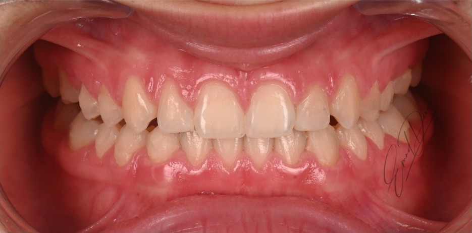 Spacing redistributed and teeth restored to full proportions after treatment