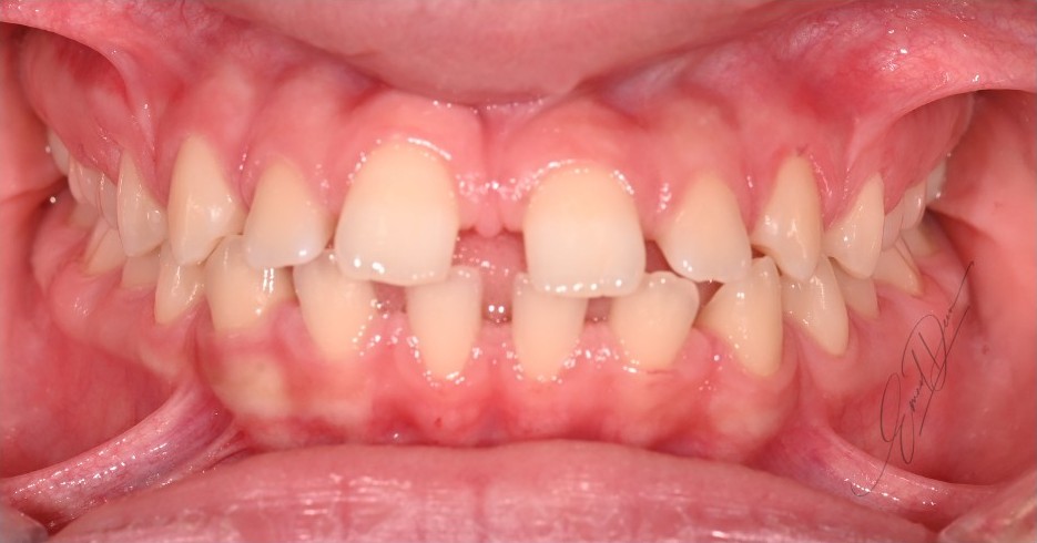 Generalised spacing across the upper arch with undersized teeth before treatment