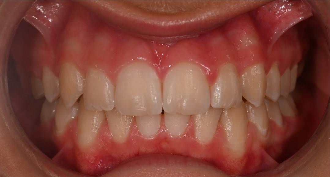 Aligned upper and lower arches after fixed appliance treatment