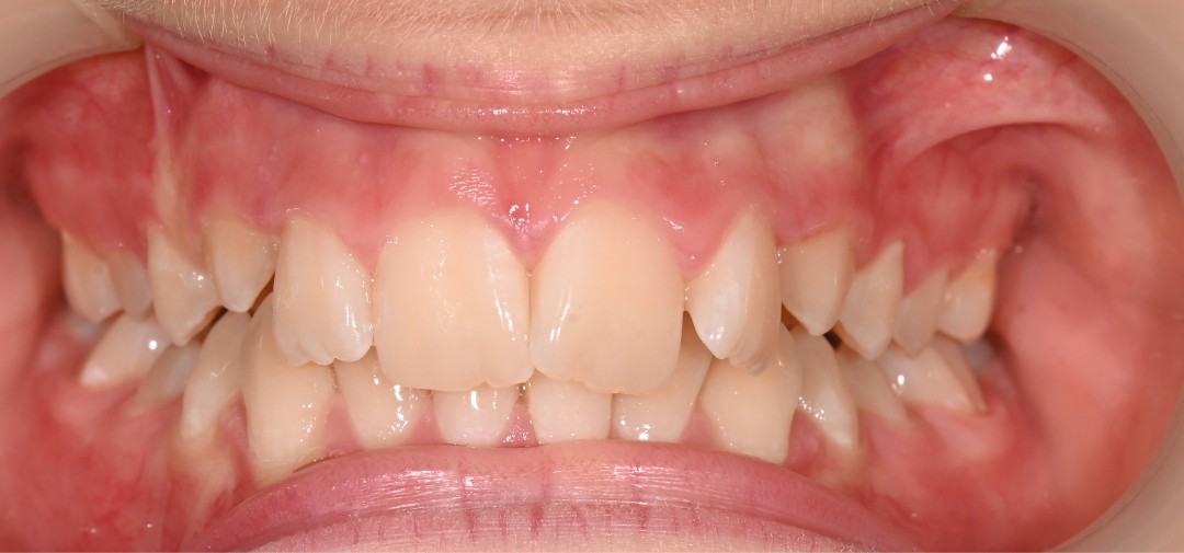 Moderate crowding with overlapping upper and lower teeth before treatment