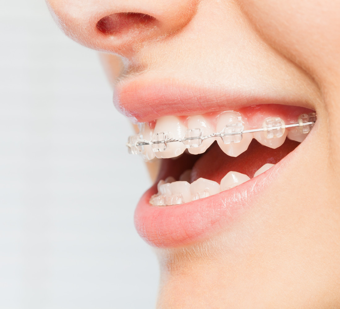 Tooth-coloured ceramic brackets blending with the natural teeth