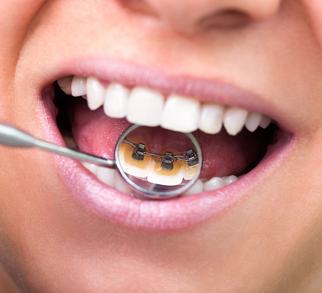 Lingual braces fitted to the inner surfaces of the teeth