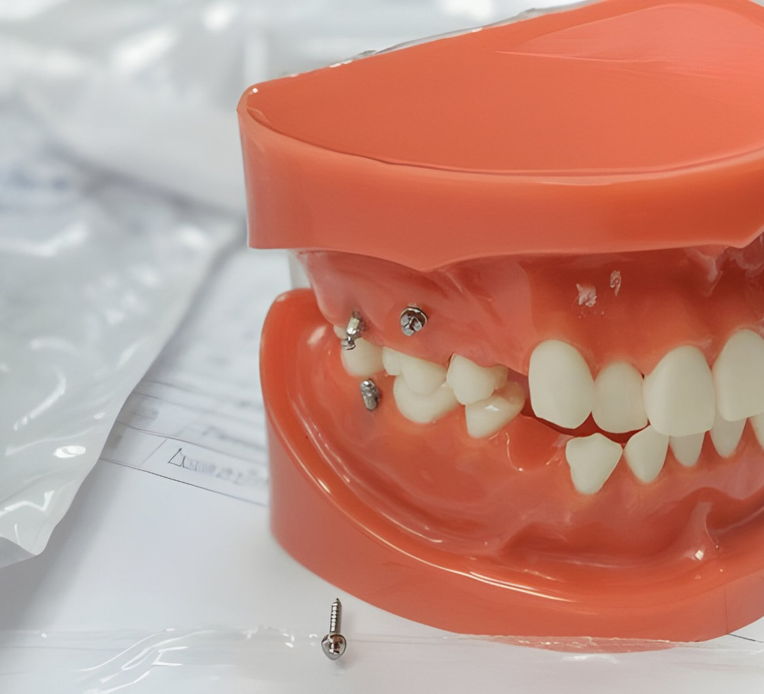 A temporary anchorage device placed in the jaw