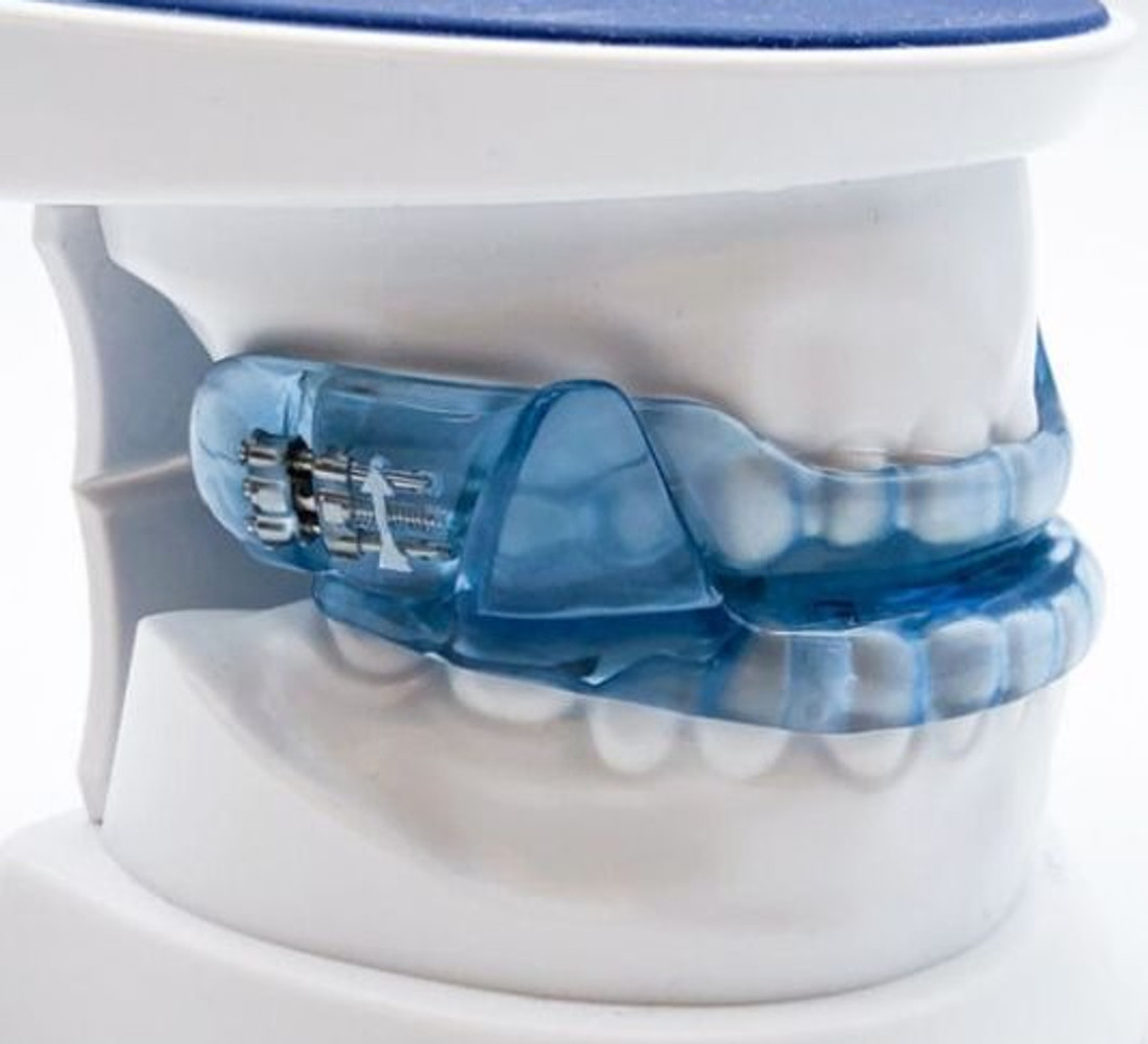 A custom oral sleep appliance